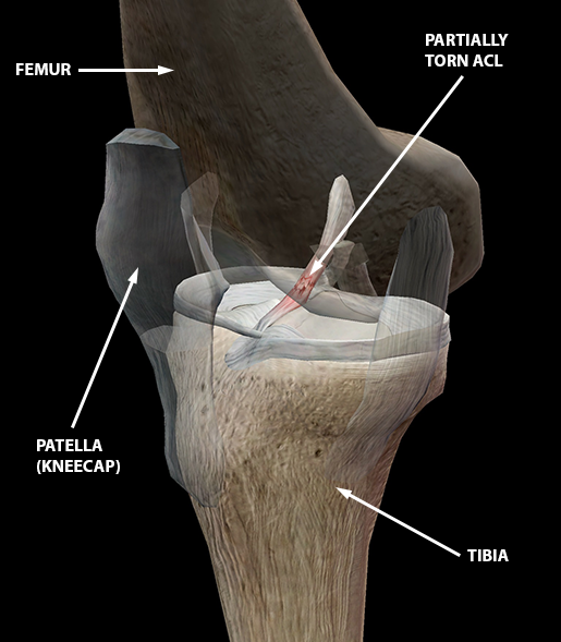 sports-injuries-acl-tear-knee-sprain